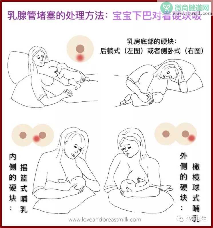 哺乳妈妈遇到堵奶了怎么办 为什么会发生堵奶