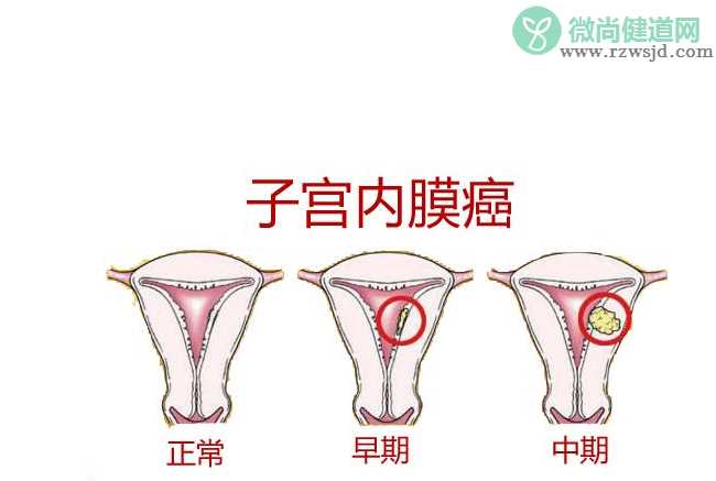 子宫内膜癌做什么检查 如何