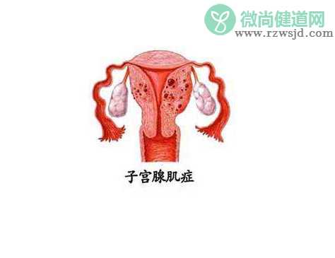 人工流产会导致子宫腺肌症吗 子宫腺肌症怀孕后如何避免流产