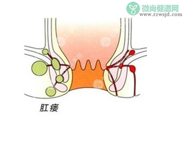 肛瘘和痔疮有什么区别 肛瘘疾病有什么危害