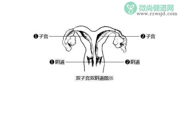 双子宫会影响怀孕吗 双子宫