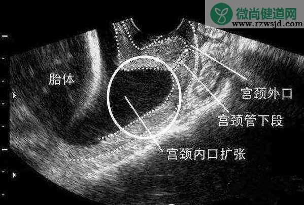 宫颈管短会引发早产吗 孕期宫颈管短怎么办