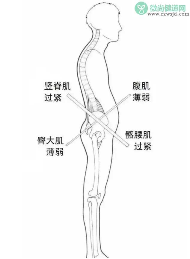 如何自测骨盆前倾 骨盆前倾怎么纠正