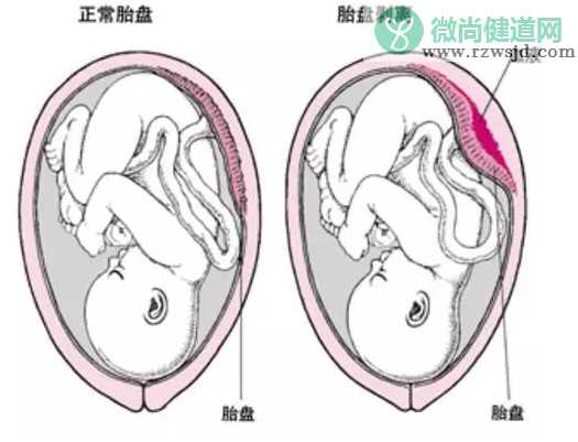 胎盘早剥前期有哪些征兆 胎盘早剥的原因是什么