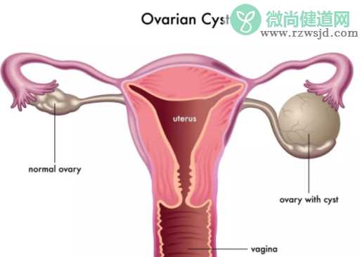 卵巢囊肿时有时无怎么回事 卵巢囊肿时有时无怎么办