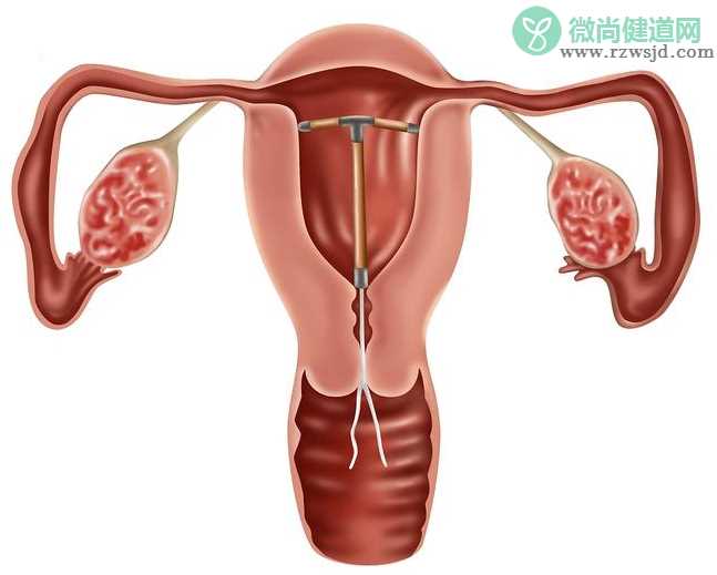 产后上环出现哪些症状要注意 产后什么时间上环比较好