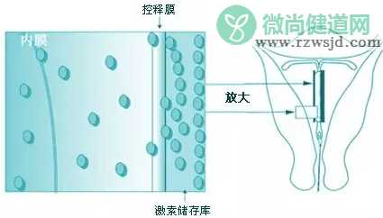 曼月乐环能够治疗哪些疾病 曼月乐环的作用与功效