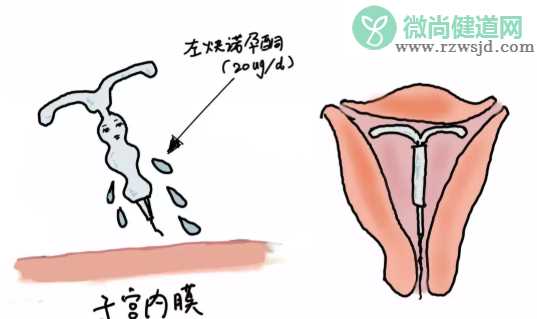 上曼月乐环后子宫会越来越大吗 上曼月乐环对子宫影响