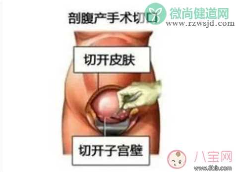 剖腹产孕妇会不会感到疼痛 剖腹产横剖还是纵剖。