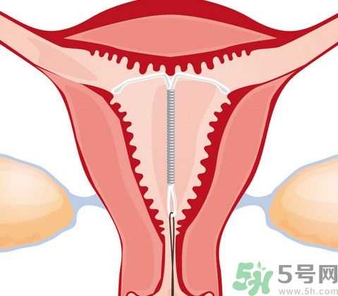 避孕环是什么?避孕环的危害