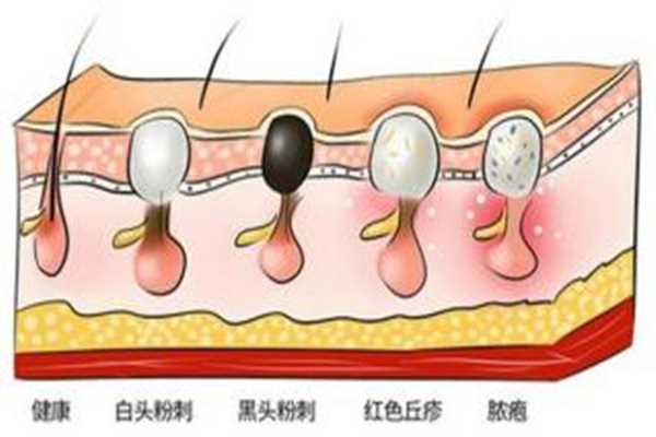 黑头可以彻底清除吗 黑头用什么洗可以轻松洗掉