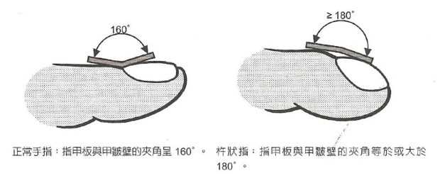 怎样看出心脏有问题 从手指、舌头眼神测试