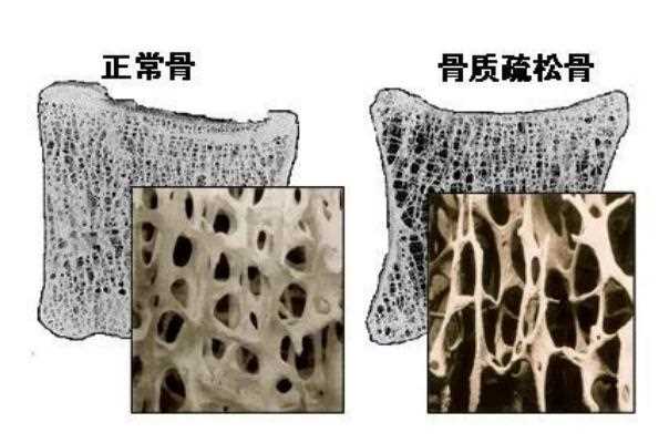 骨质疏松有哪些症状表现 骨质疏松怎么治才能彻底治好