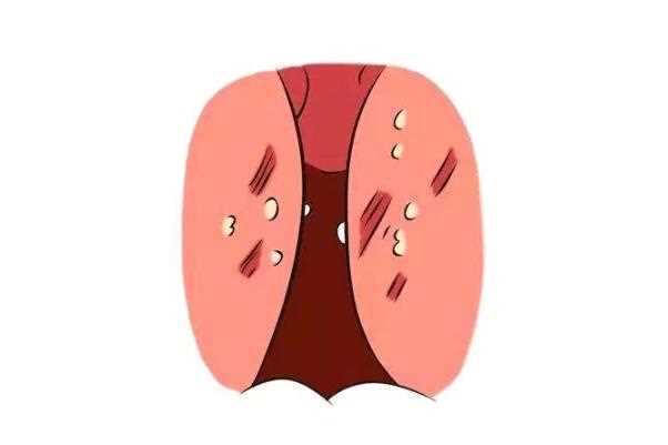 扁桃体发炎有脓点严重吗 扁桃体发炎有遗传性吗