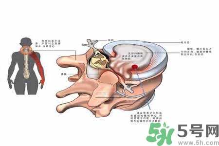 为什么年轻人容易得颈椎病？颈椎病严重的症状有哪些？