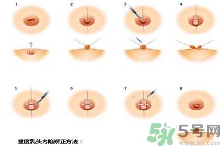 乳头内陷怎么回事？乳头内陷的原因是什么？