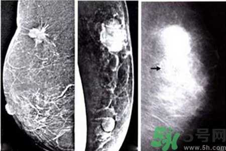 产生乳腺增生钙化的病因是什么？乳腺增生怎样治疗？