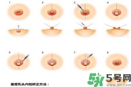 乳头内陷怎么矫正？乳头内陷矫正方法是什么？