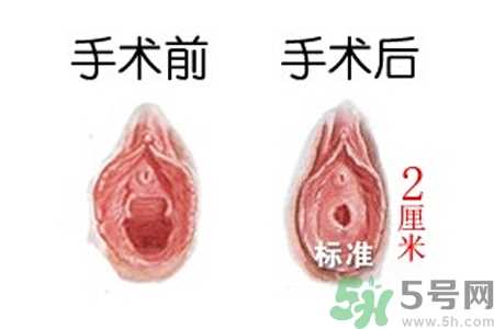 什么人不能做处女膜修补术？处女膜修补术会留疤吗？