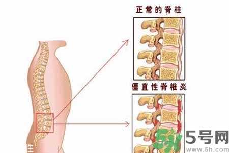 僵直性脊椎炎的症状有哪些？怎样预防僵直性脊椎炎？