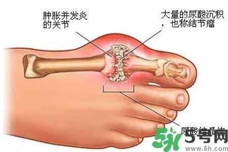 引发痛风的原因是什么？痛风病人饮食需注意什么好？