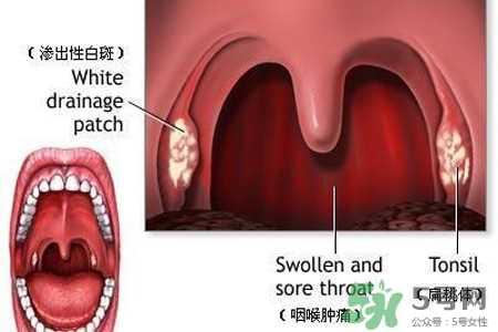 雾霾天喉咙痛怎么办？雾霾天嗓子疼怎么办？