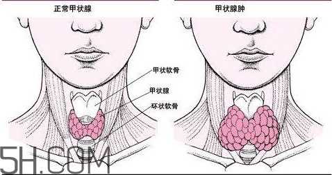 甲状腺结节与甲状腺肿瘤的区