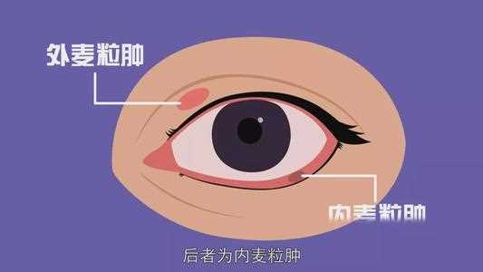 麦粒肿可以戴隐形眼镜吗 麦粒肿能传染吗