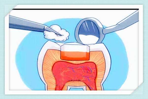 补牙后可以吃什么 牙齿有洞不补会怎样