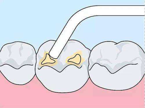 补牙后可以吃什么 牙齿有洞不补会怎样