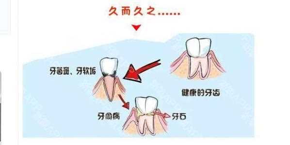 洗牙有哪些坏处呢 洗牙有哪些危害呢