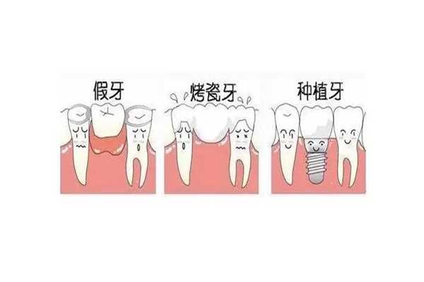 烤瓷牙是不是越贵越好 烤瓷牙是永久的吗