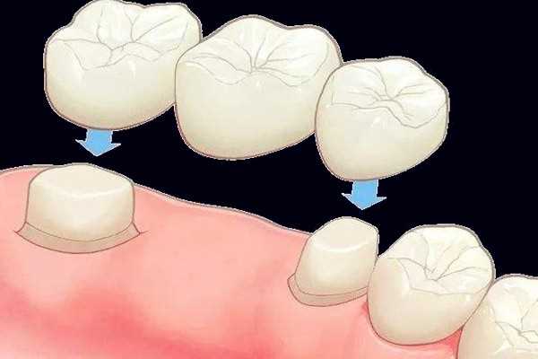 烤瓷牙什么人不能做 烤瓷牙能用冲牙器吗