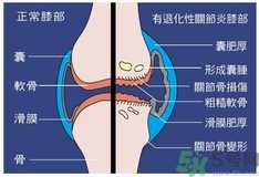 骨关节炎能治好吗？骨关节炎平时注意事项