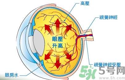 青光眼可以治愈吗？青光眼怎样治疗？