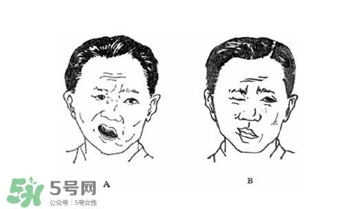 面瘫是什么导致的？面瘫多久彻底恢复正常