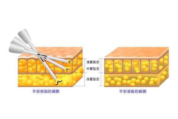 抽脂肪对身体有什么副作用 