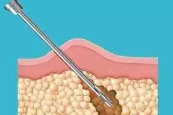 溶脂针的效果和副作用 溶脂针价格多少钱一针