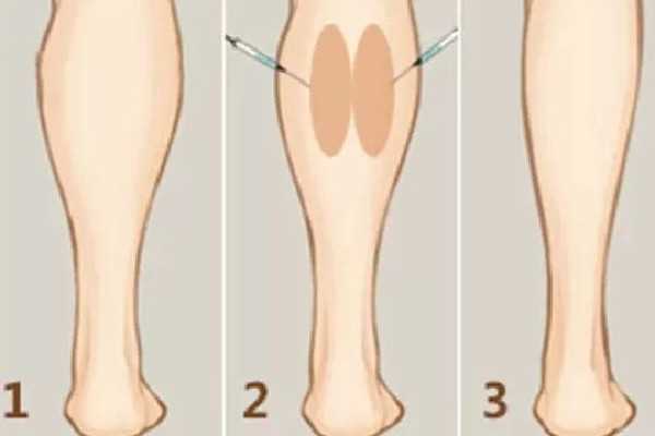 武汉打瘦腿针的医院推荐 武汉打瘦腿针要多少钱