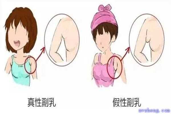 副乳是赘肉吗 副乳跟赘肉的区别