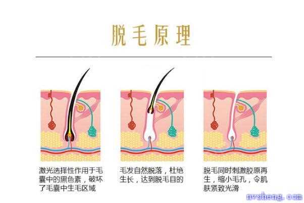 激光脱毛有烧焦的味道 脱毛仪为什么会有烧焦味