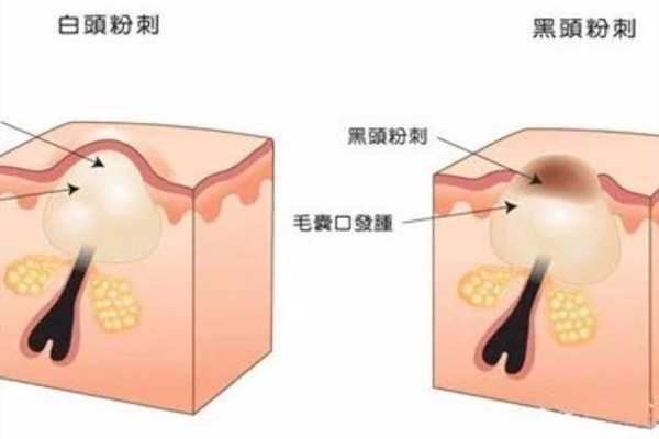 毛角周化和闭口的区别 毛角周化和闭口怎么区分