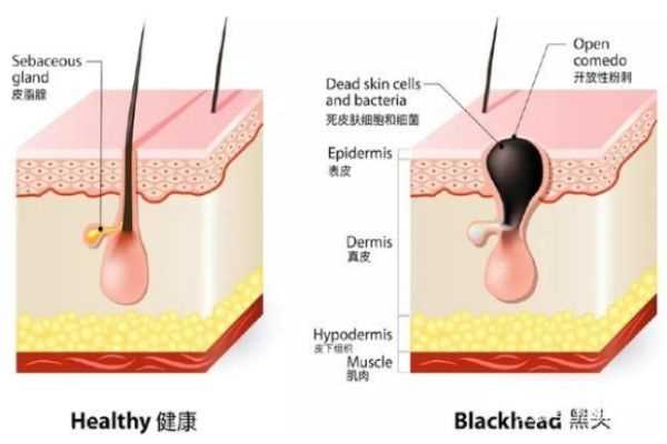 黑头导出液什么牌子好 四大品牌让你和黑头说拜拜