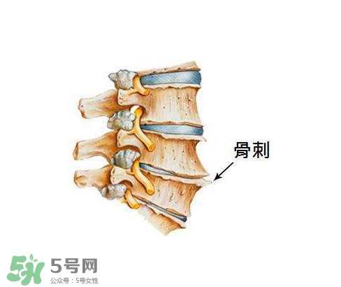 骨刺是怎么形成的？骨刺怎么治疗？