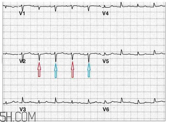心电图怎么看？6种常见心电图异常情况