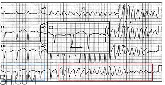 心电图怎么看？6种常见心电图异常情况