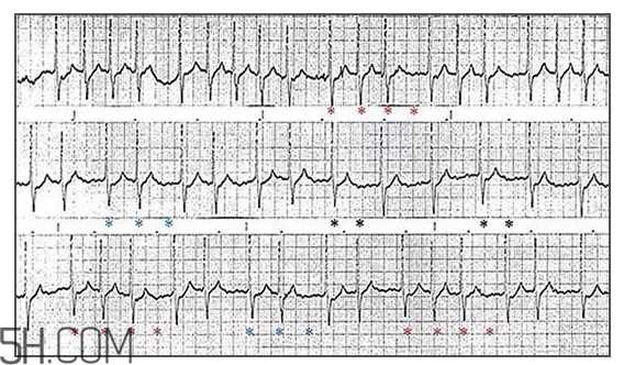 心电图怎么看？6种常见心电图异常情况