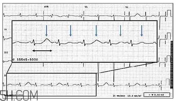 心电图怎么看？6种常见心电图异常情况