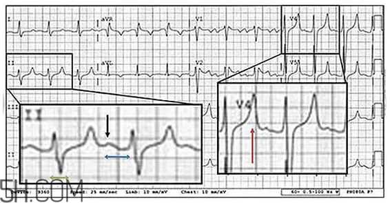 心电图怎么看？6种常见心电图异常情况