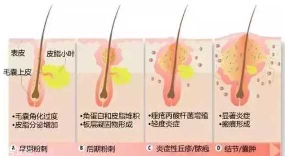 封闭性粉刺的发病机制是什么？角质层太厚